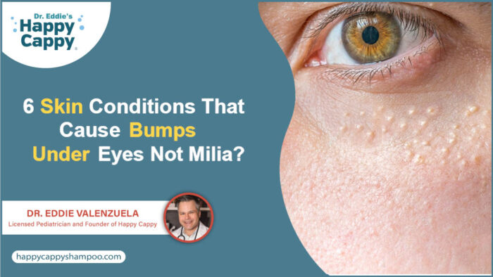 Skin Conditions That Cause Bumps Under Eyes Not Milia