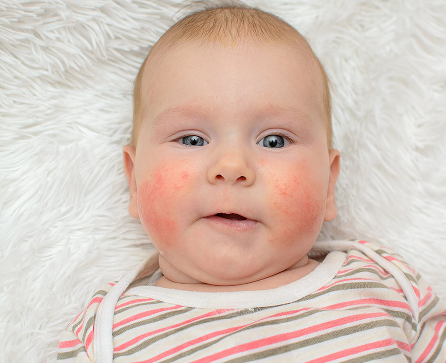 A baby with eczema