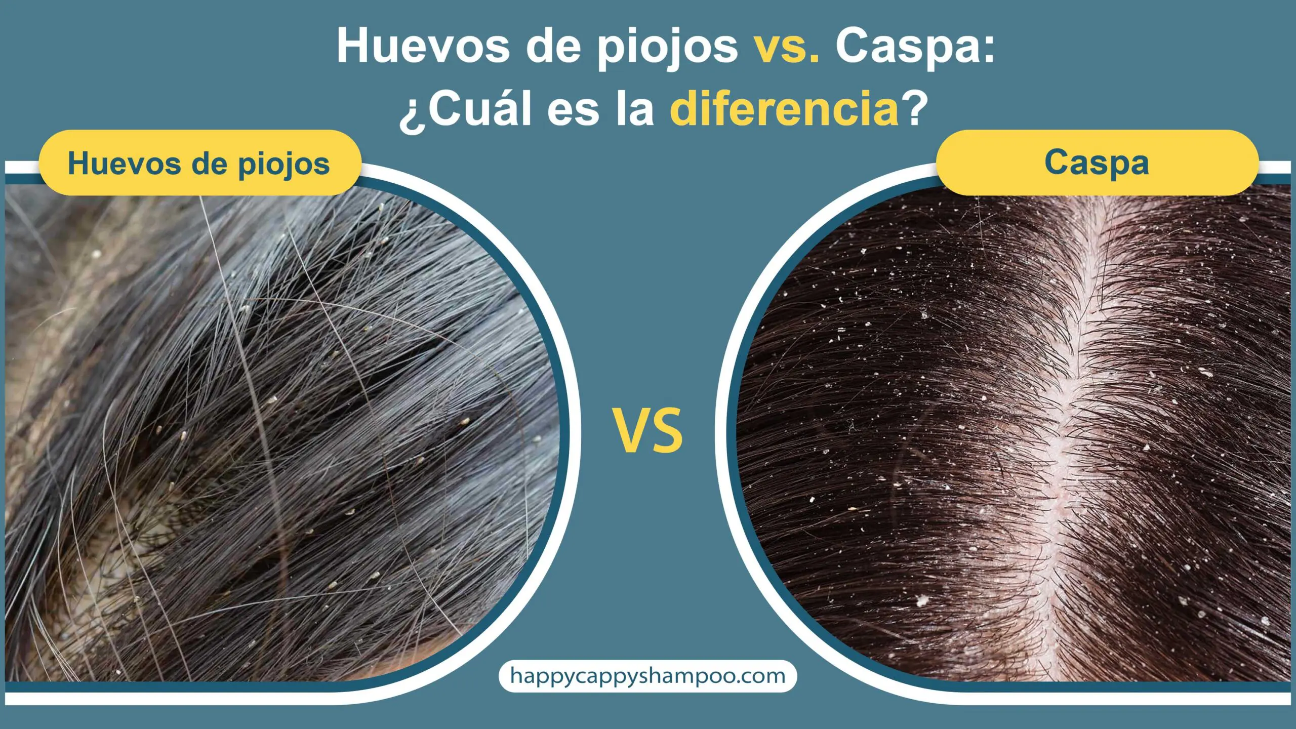 Huevos de piojos vs. Caspa: ¿Cuál es la diferencia?