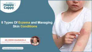 8 Types Of Eczema and Managing Skin Conditions