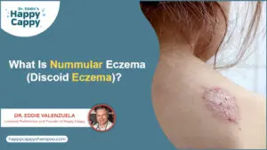Nummular Eczema (Discoid Eczema)