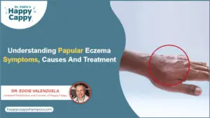 Papular Eczema
