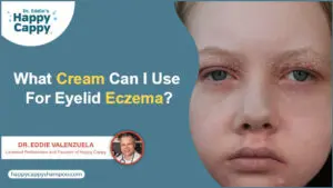 What cream can i use for eyelid eczema