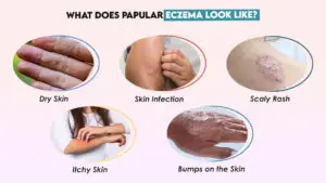 What Does Papular Eczema Look Like?