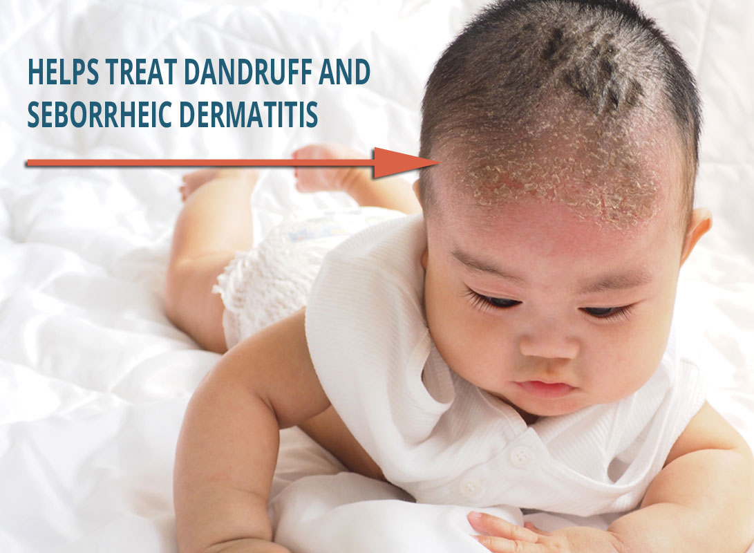 Child Seborrheic Dermatitis & Dandruff Dr. Eddie's Happy Cappy