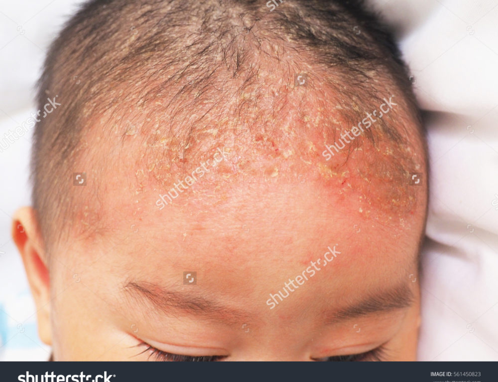 Seborrheic Dermatitis Dr. Eddie's Happy Cappy