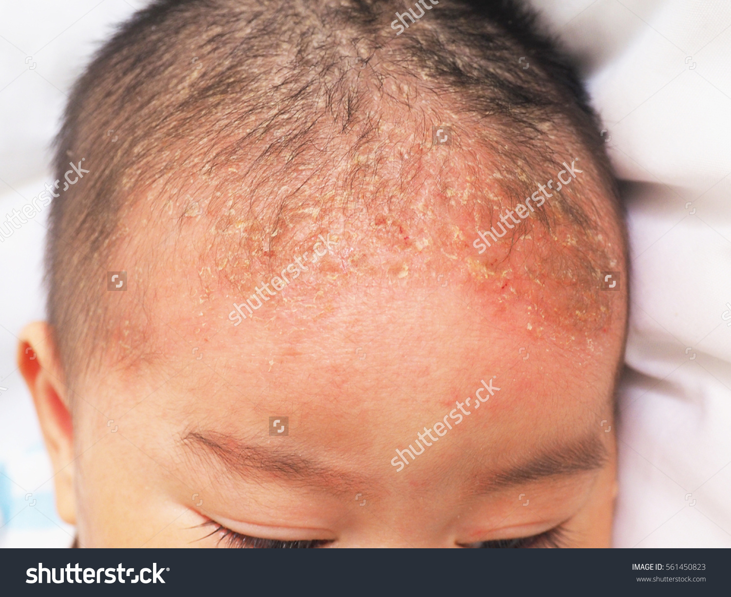 Seborrheic Dermatitis Dr. Eddie's Happy Cappy