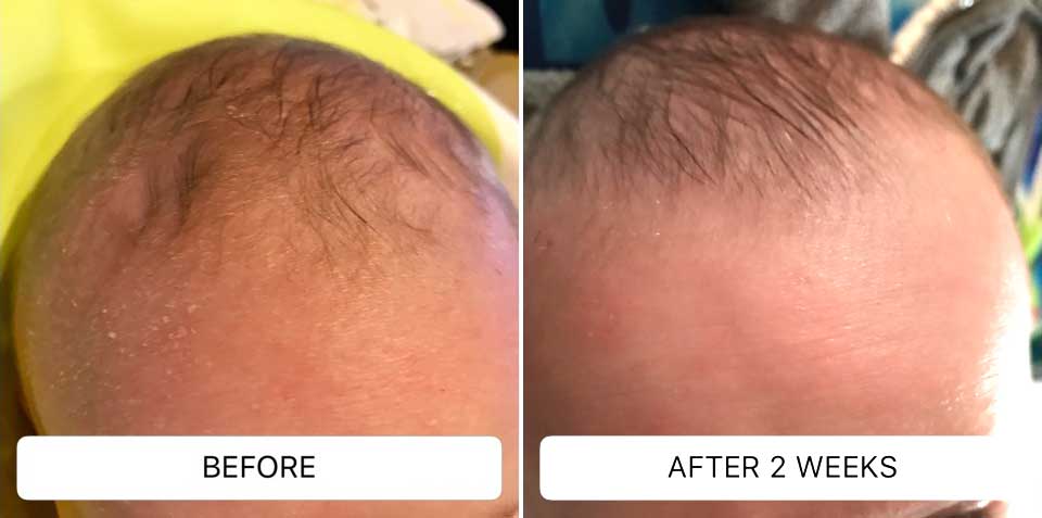 Fotos de antes y después de bebés que han usado champú para la costra láctea