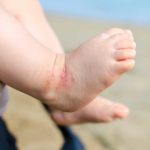 What Does Eczema Look Like on a Baby's ankle?
