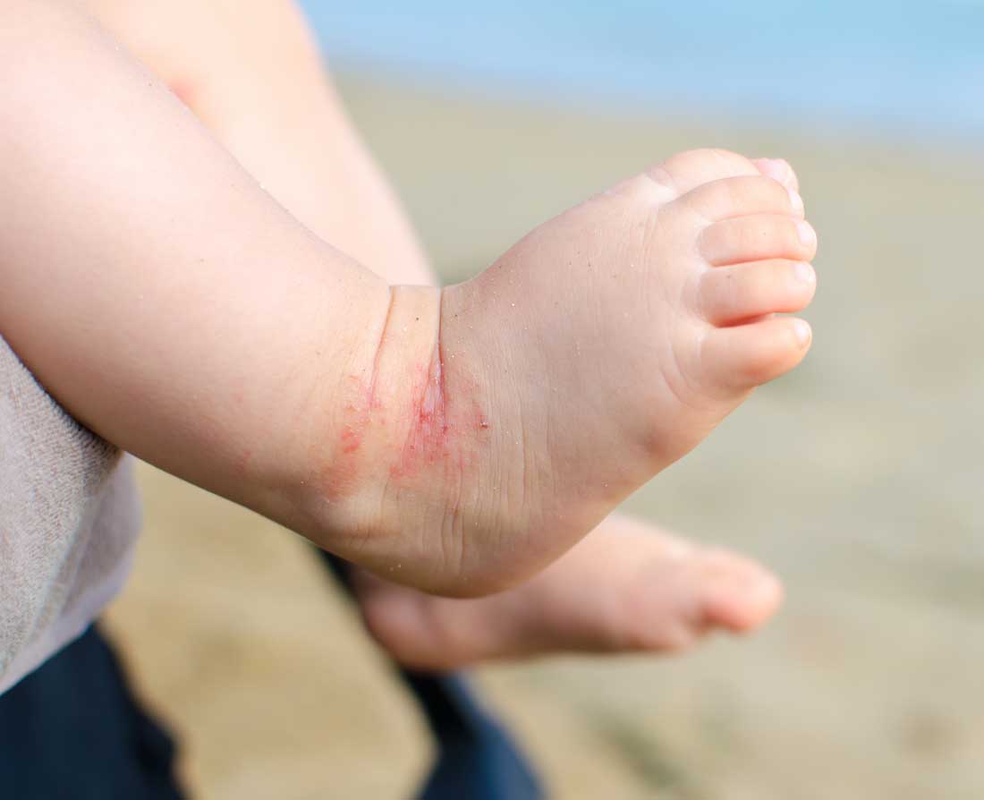 What Does Eczema Look Like On A Baby?