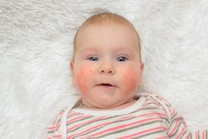 What Does Eczema Look Like on a Baby's cheek