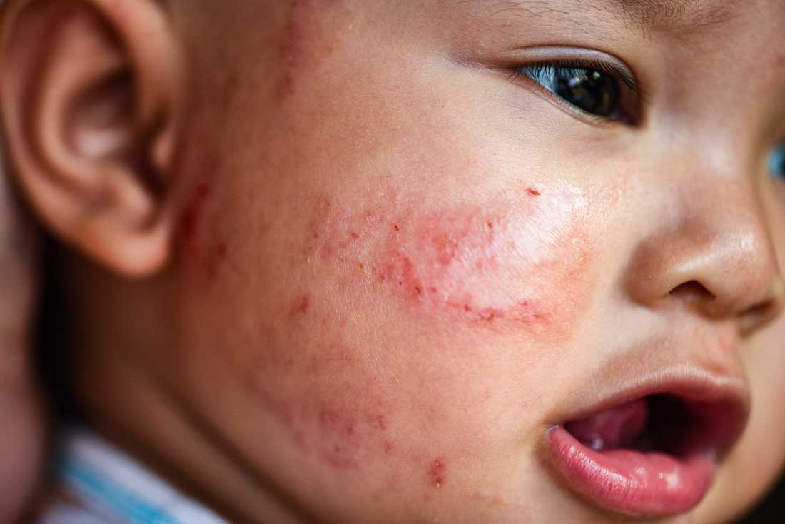 What Does Eczema Look Like on a Baby 7