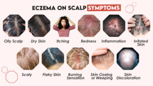 Eczema-on-Scalp-Symptoms