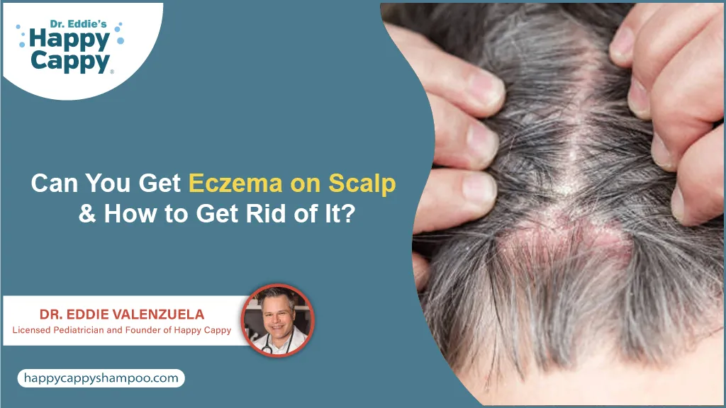 Can You Get Eczema on Scalp and How to Get Rid of It?