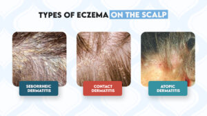 Types of Eczema on the Scalp