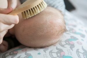Baby with cradle cap, parent using brush to comb out cradle cap