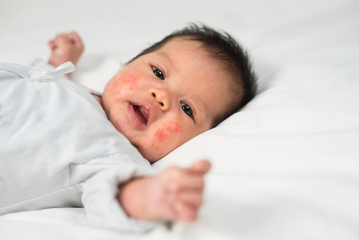 Newborn with neonatal acne