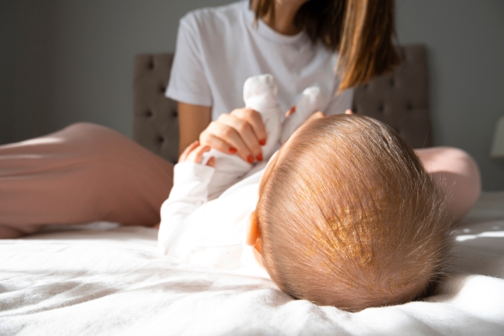 Baby with parent - showing infantile seborrheic dermatitis AKA cradle cap