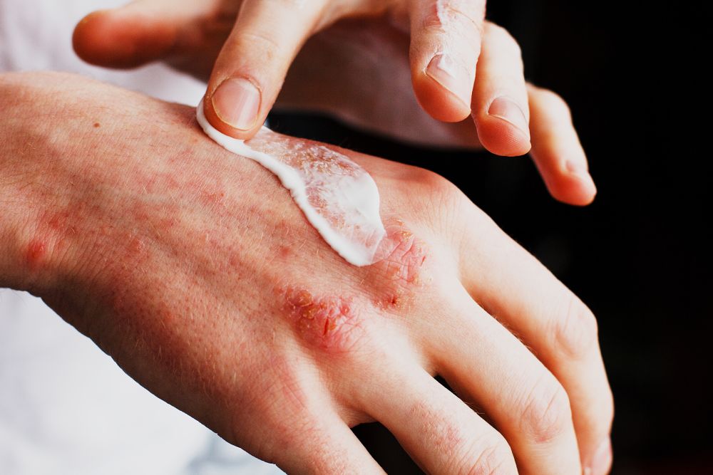 What-Does-Eczema-Look-Like-on-a-Baby