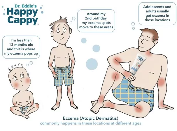 Eczema in different ages