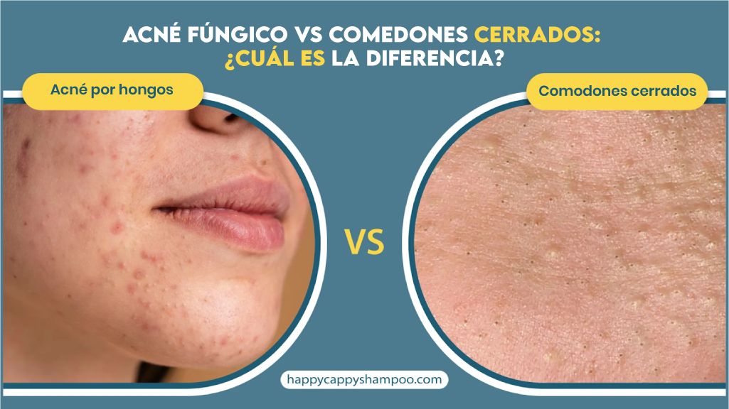 Acné Fúngico Vs Comedones Cerrados: ¿Cuál es la Diferencia?