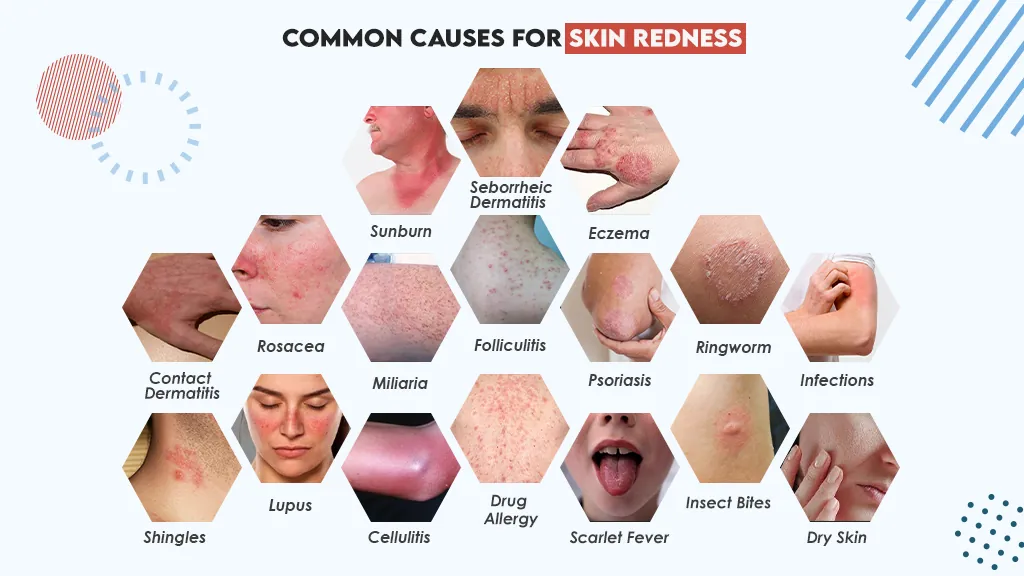 Common Causes for Skin Redness