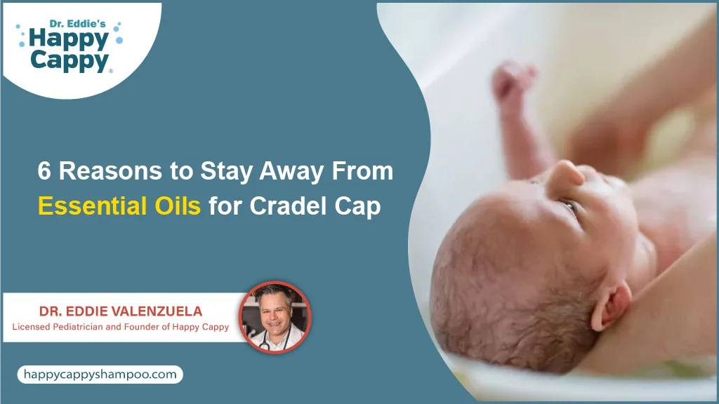 6 Reasons to Stay Away From Essential Oils for Cradle Cap