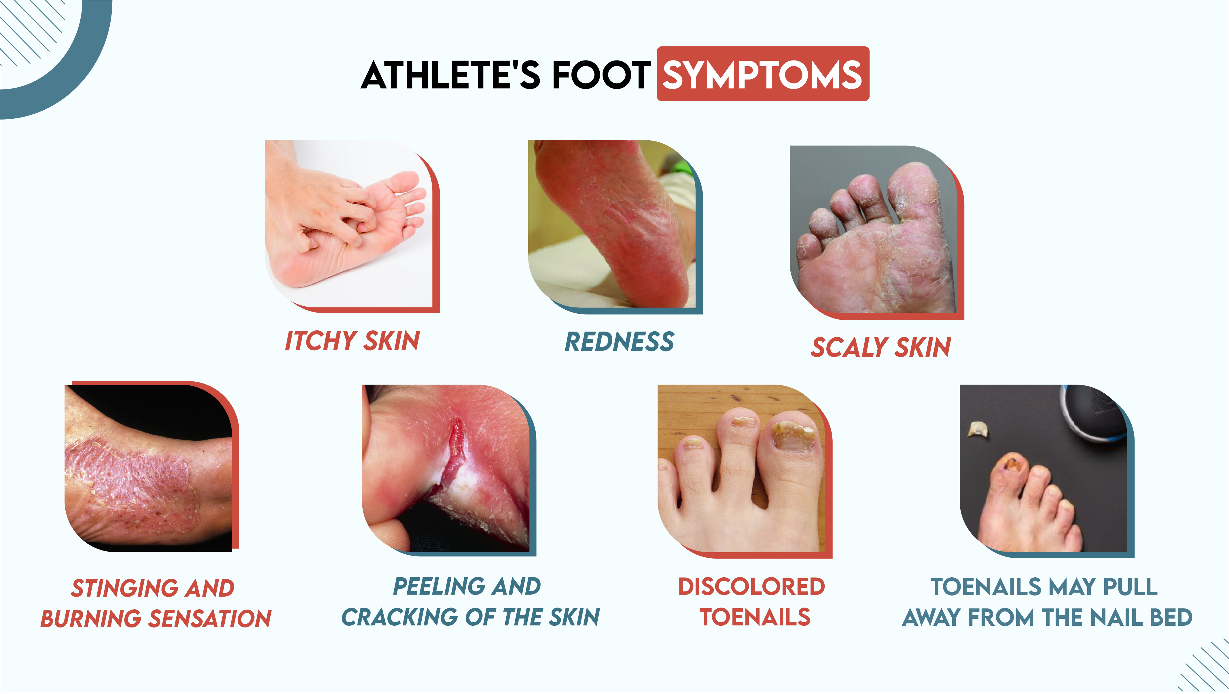 Athlete's Foot Symptoms