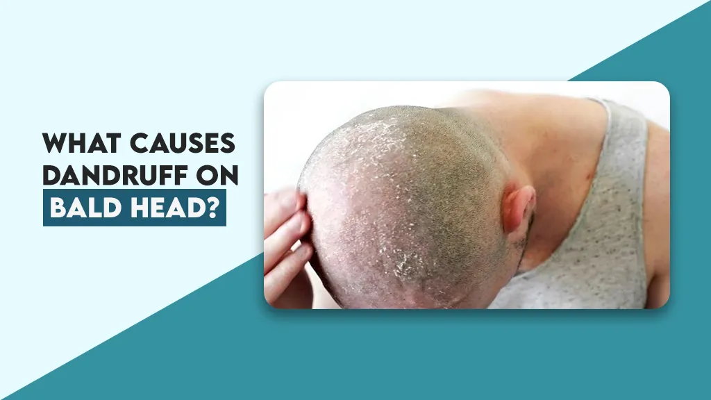 What Causes Dandruff on Bald Head?