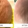 cradle cap before and after