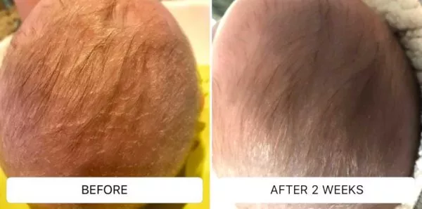 CRADLE CAP BEFORE AND AFTER