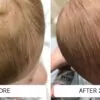 cradle cap before and after