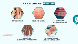 Can Eczema Get Infected?