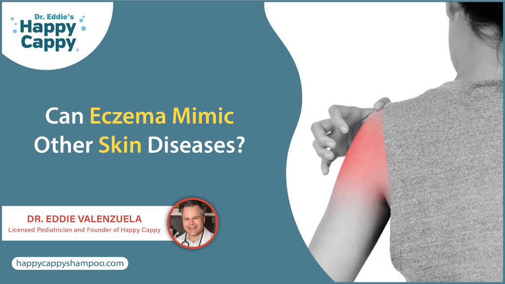 Can Eczema Mimic Other Skin Diseases