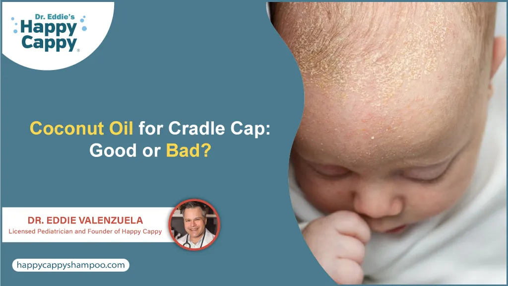 Coconut Oil for Cradle Cap: Good or Bad?