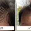 cradle cap before and after