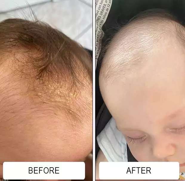 Before and after cradle cap