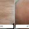 Before and after cradle cap