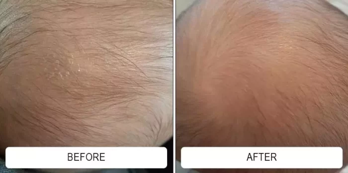 Before and after cradle cap