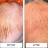 cradle cap before and after