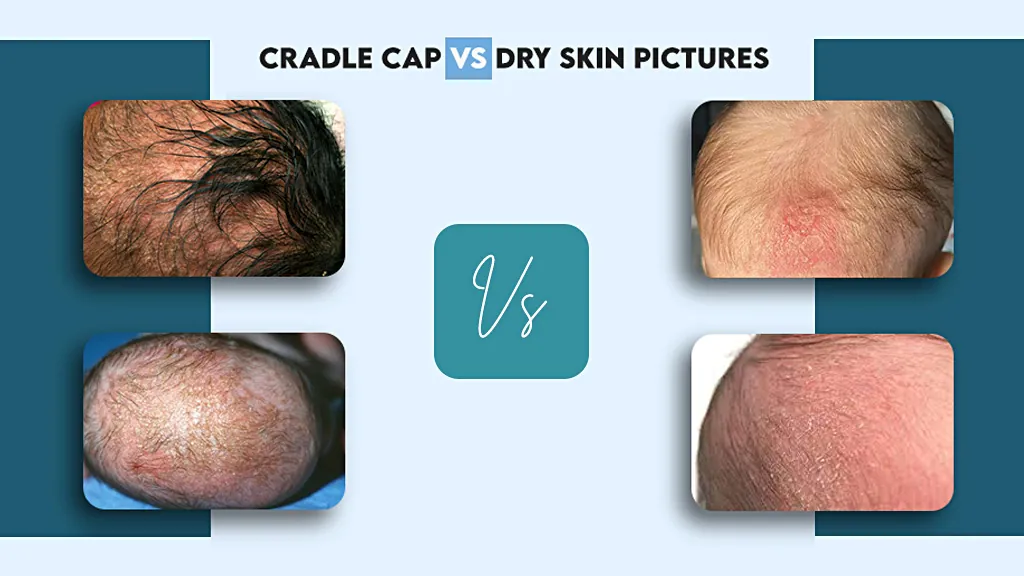 Cradle Cap Vs Dry Skin