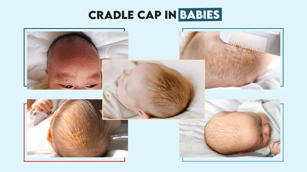 Cradle-Cap-in-Babies-symptoms