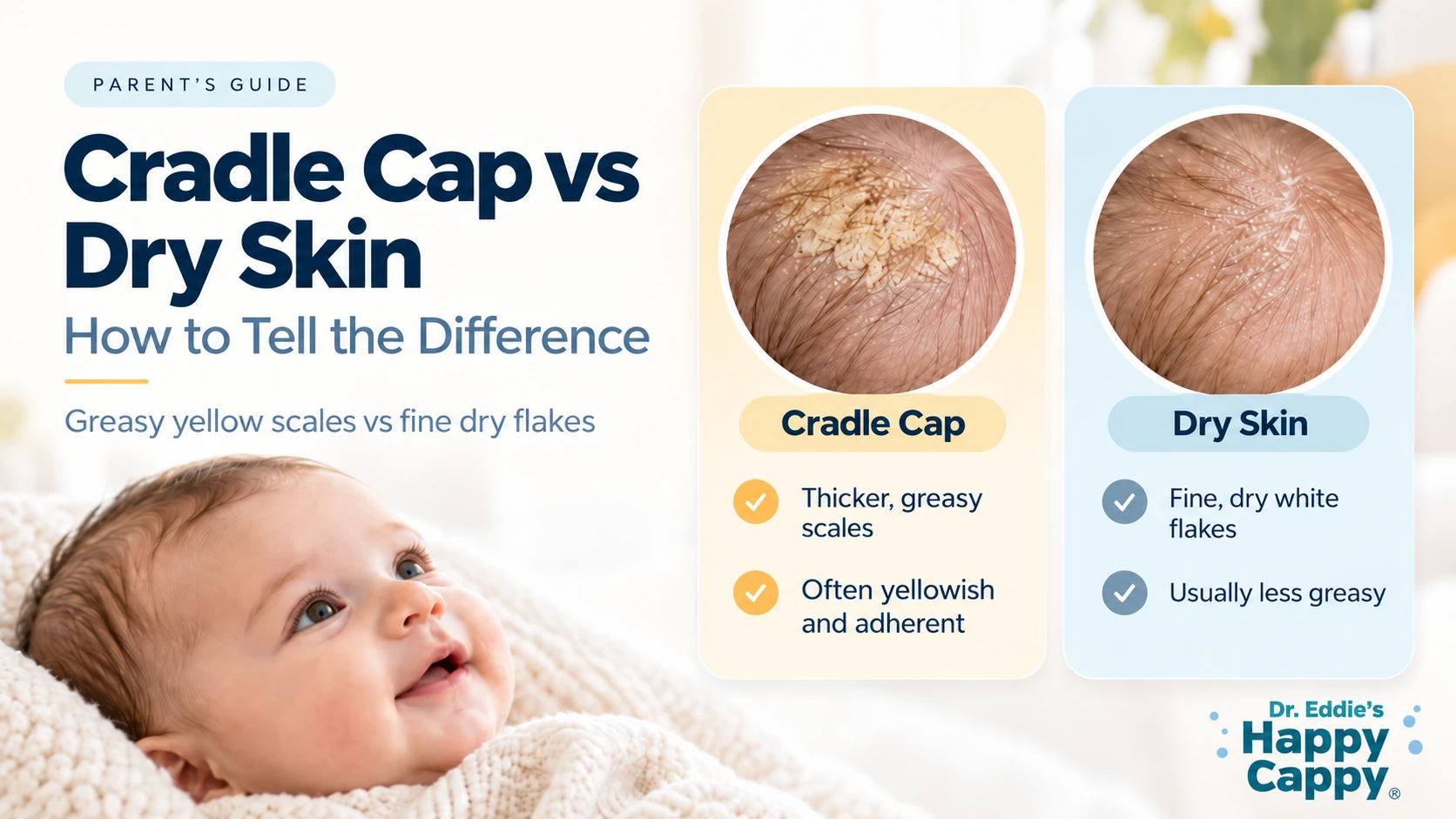 Cradle Cap vs Dry Skin: How to Tell the Difference