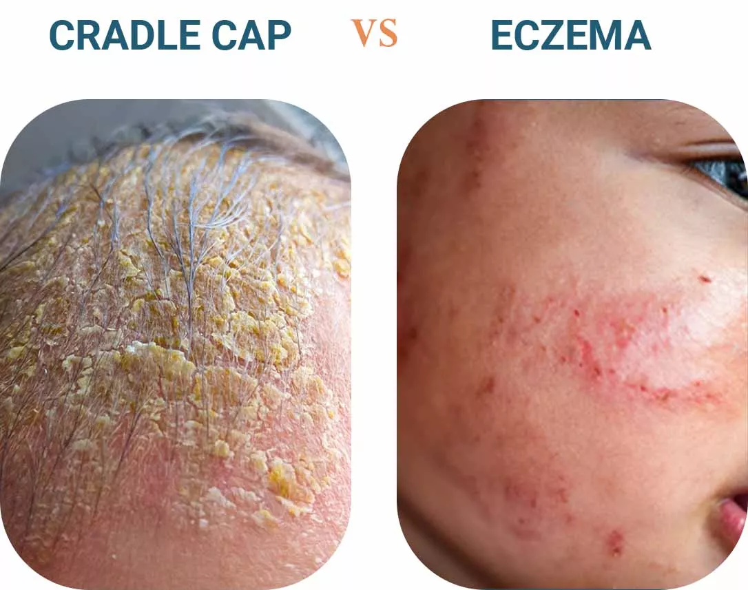 Cradle cap vs eczema: what's the difference?