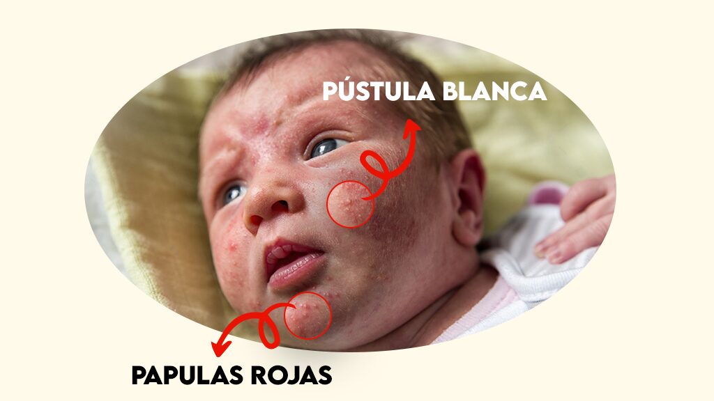 Síntomas del Acné Neonatal