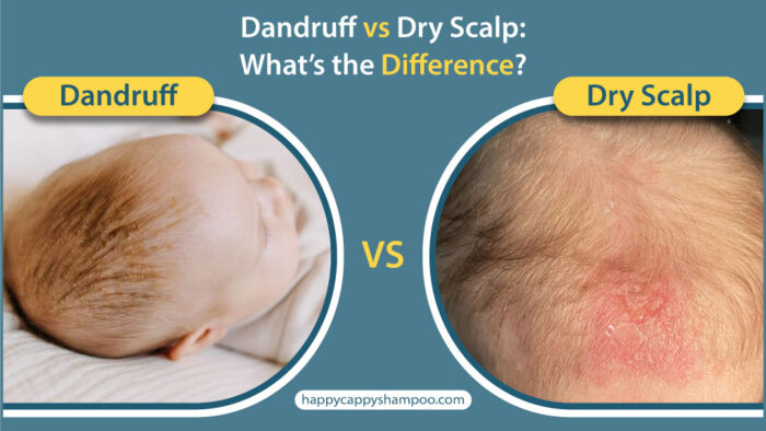 Dandruff Vs Dry Scalp: What’s The Difference?