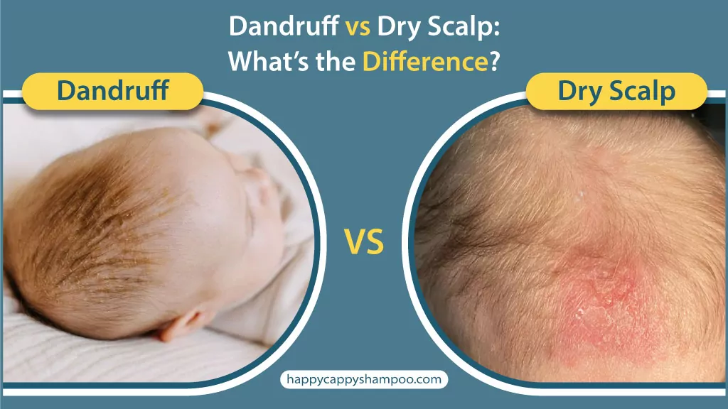 Dandruff vs Dry Scalp: What’s the Difference?