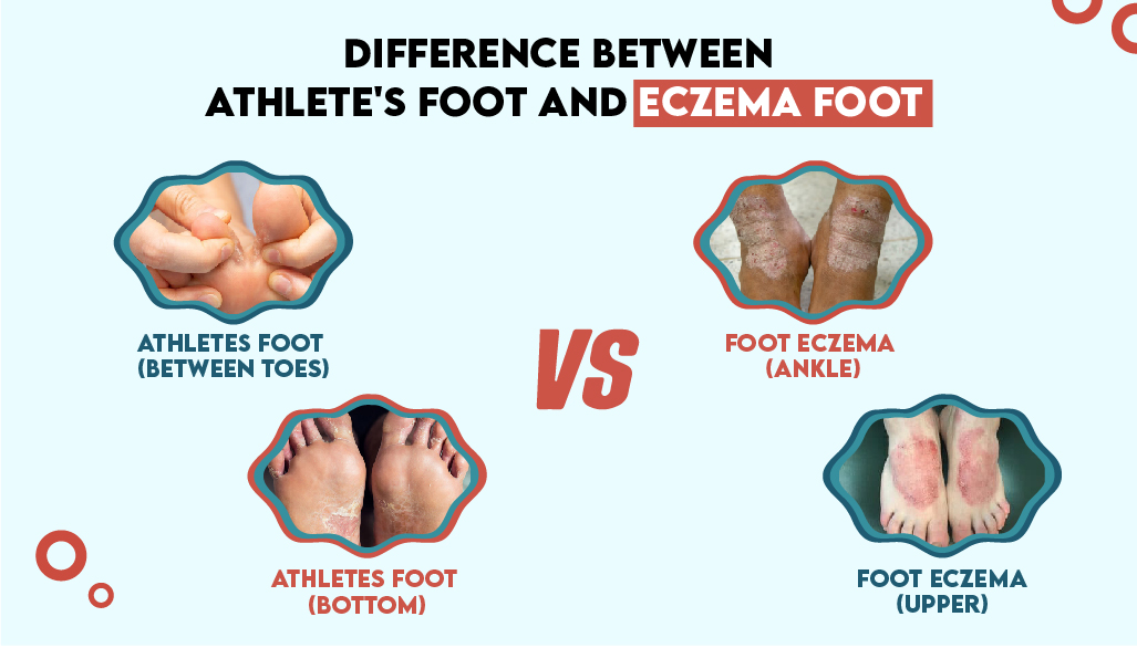 Difference Between Athlete's Foot and Eczema Foot