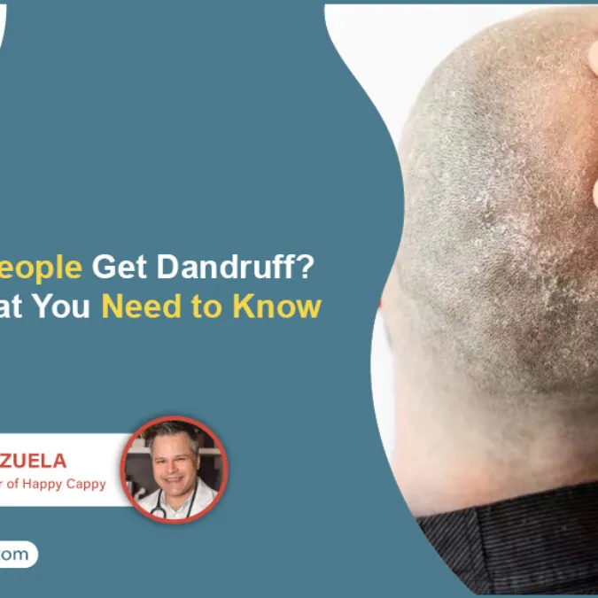 Do Bald People Get Dandruff? Here&rsquo;s What You Need to Know - Happy 