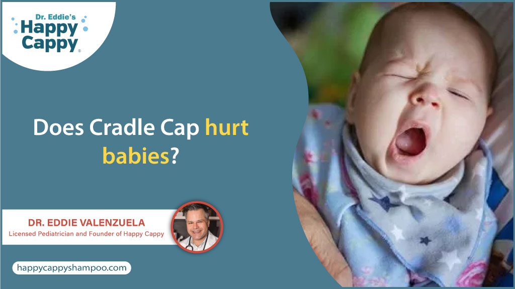 Does Cradle Cap hurt babies?